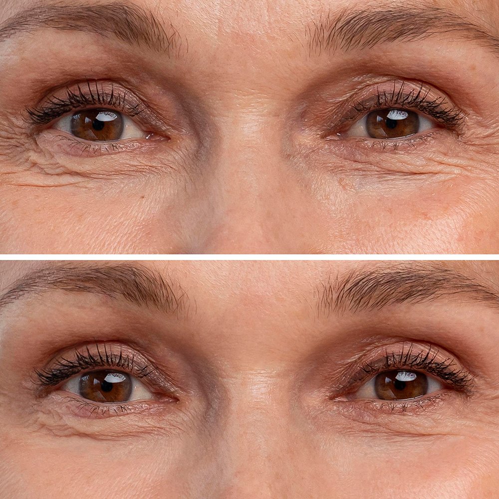 Blefaroplastia