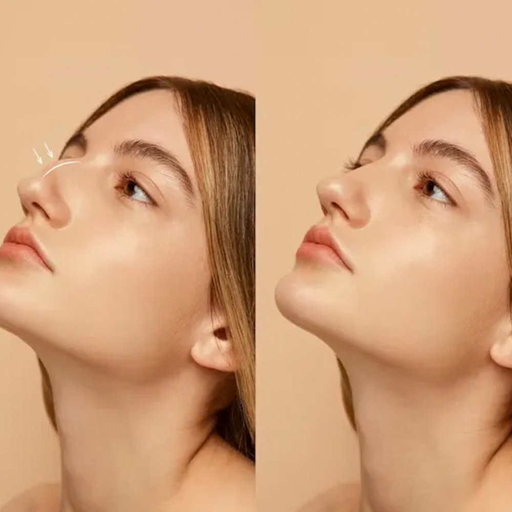 Rinoplastia