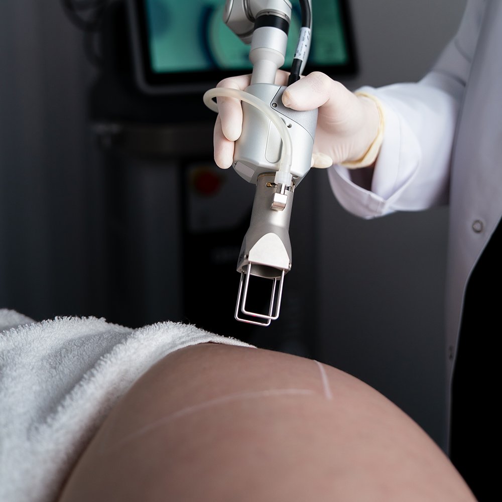 Tratamento de estrias com laser CO₂ - imagem 1