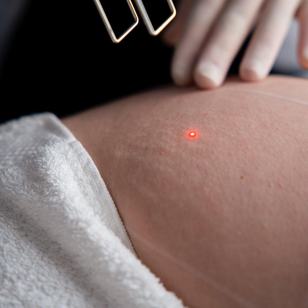 Tratamento de estrias com laser CO₂ - imagem 3