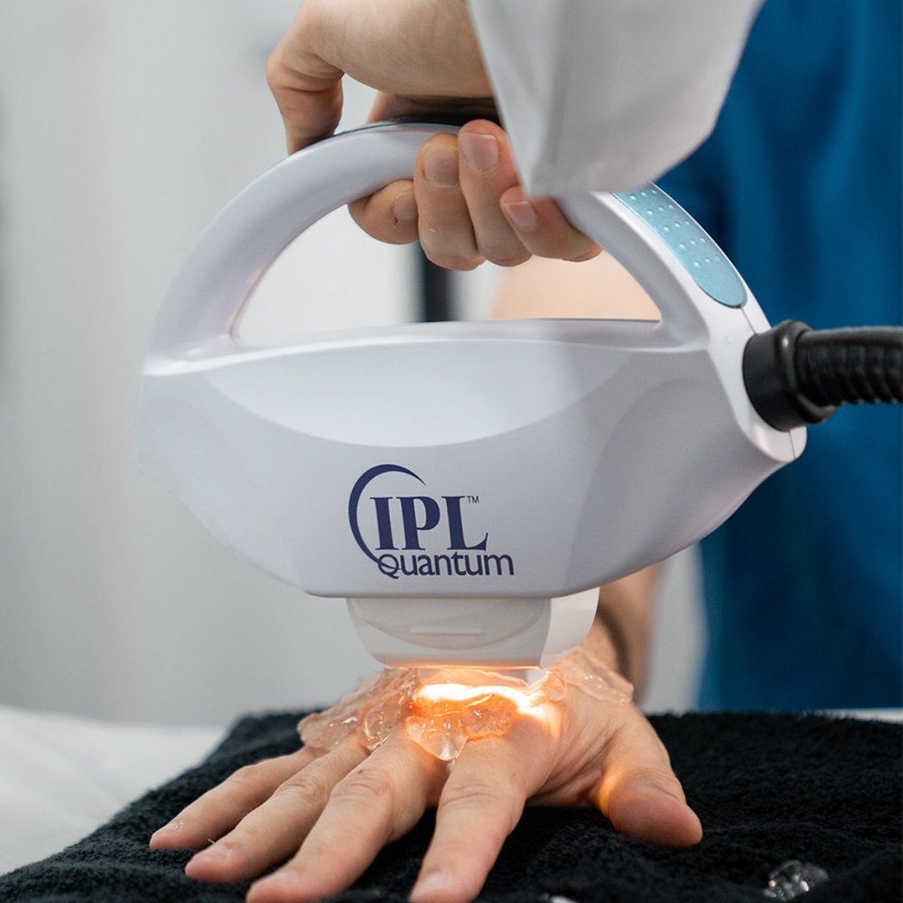 Tratamento IPL corporal