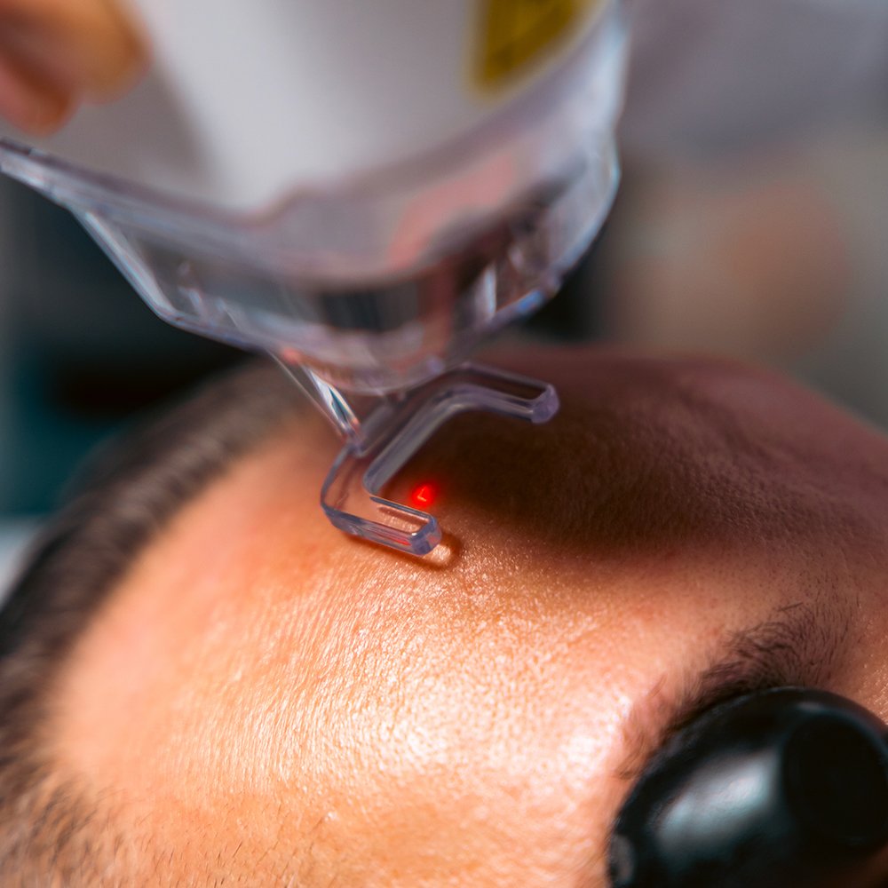 Tratamento Laser CO₂
