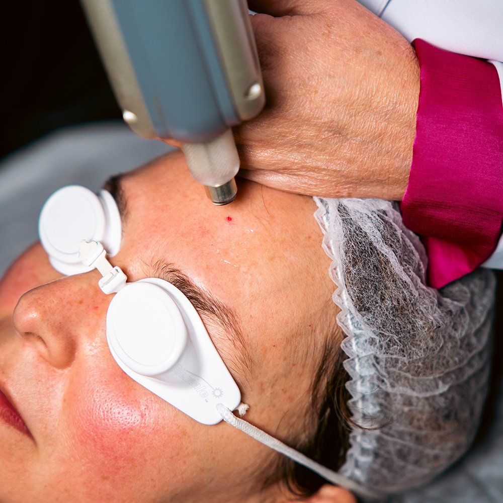 Tratamento Laser Vasculight Facial